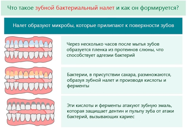 Что такое зубной бактериальный налет и как он формируется